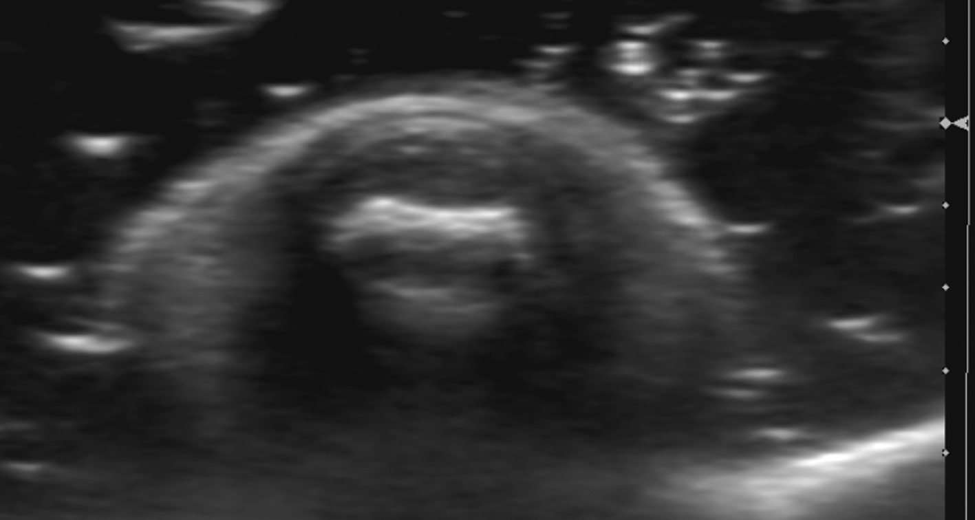 Figure 2 for case glomus tumor ( RID4513 )